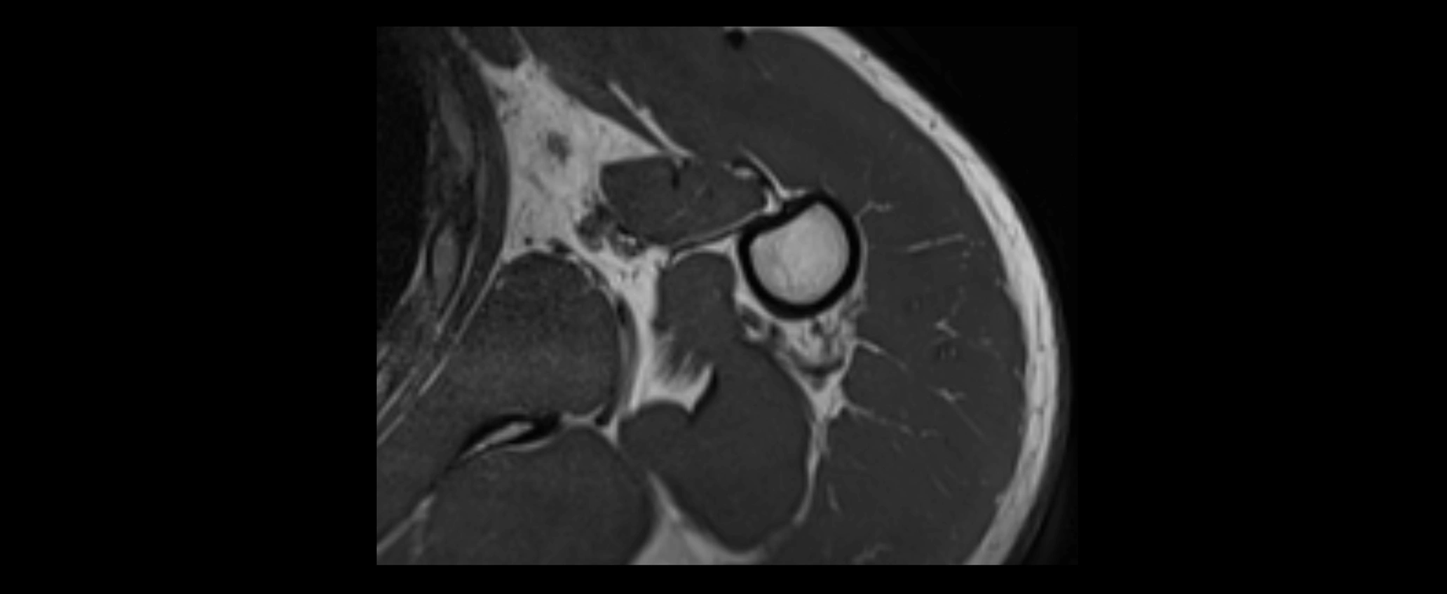 shoulder ligaments axial 3d 3t mri image-img-00005-00105.webp